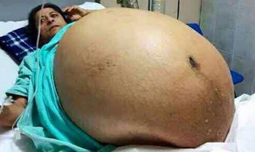 Basına hamilelik pozları verilmişti, meğer hamile değilmiş! Doktorlar bile şaşırdı, bebek sandıkları şey aslında...