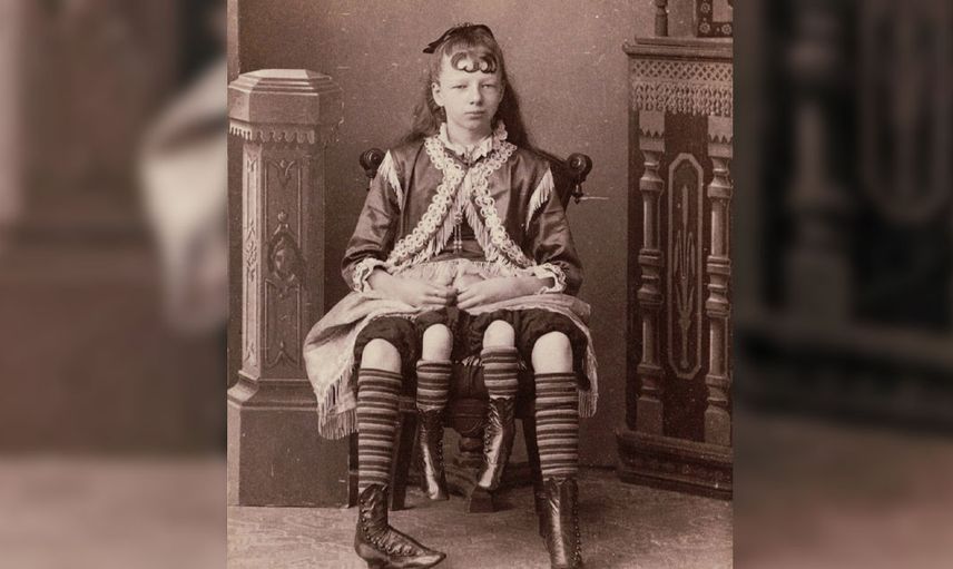 Dört bacak ve iki rahimle doğan kadın Myrtle Corbin'nin hayat hikayesi