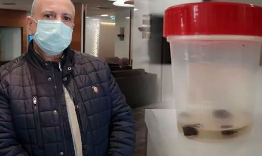 32 yıl sonra akciğerinden öyle bir şey çıktı ki