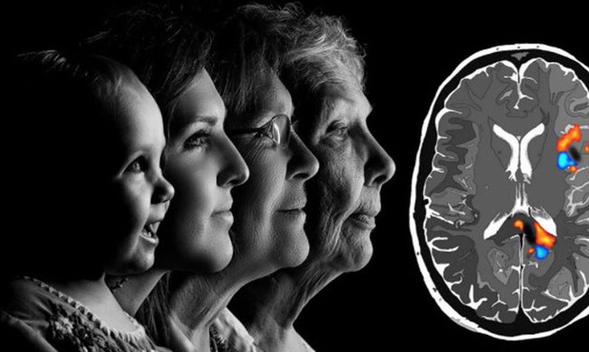 Alzheimer’ın İlk Belirtileri 20 Yıl Önce Başlıyor
