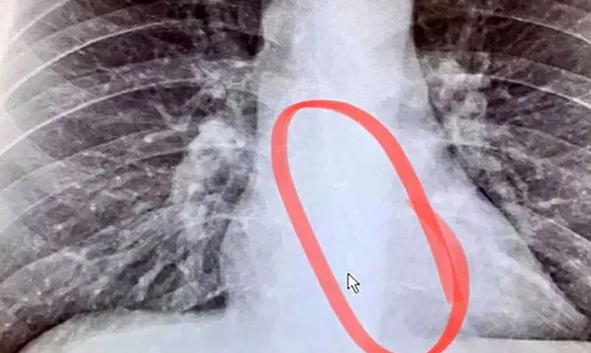 Boğaz Kuruluğu Şikayetiyle Doktora Gitti Hayatının Şokunu Yaşadı