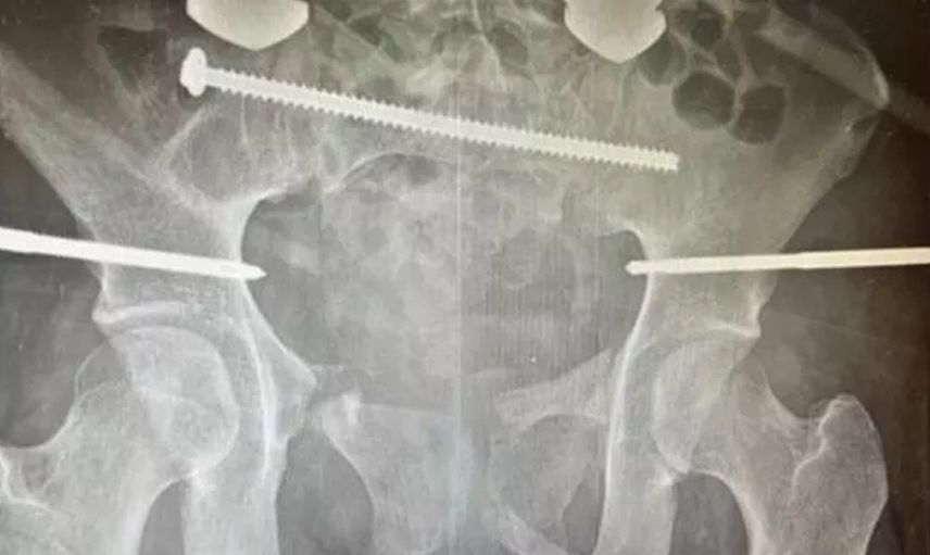 Böylesi daha önce görülmedi! Vücudu ikiye ayrılan kadın için doktorlar yaşama ihtimali yüzde sıfır demişti son hali herkesi şaşırttı
