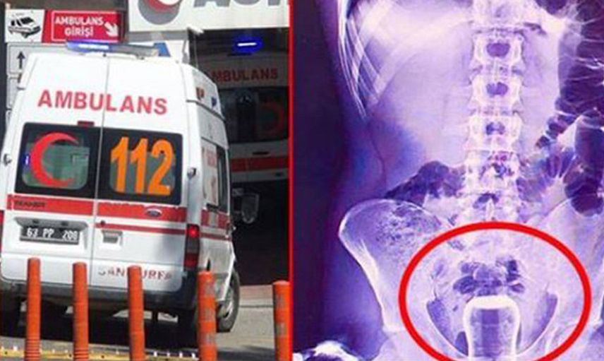 'Bu buraya nasıl girdi?' diyeceğiniz birbirinden garip röntgen filmleri!