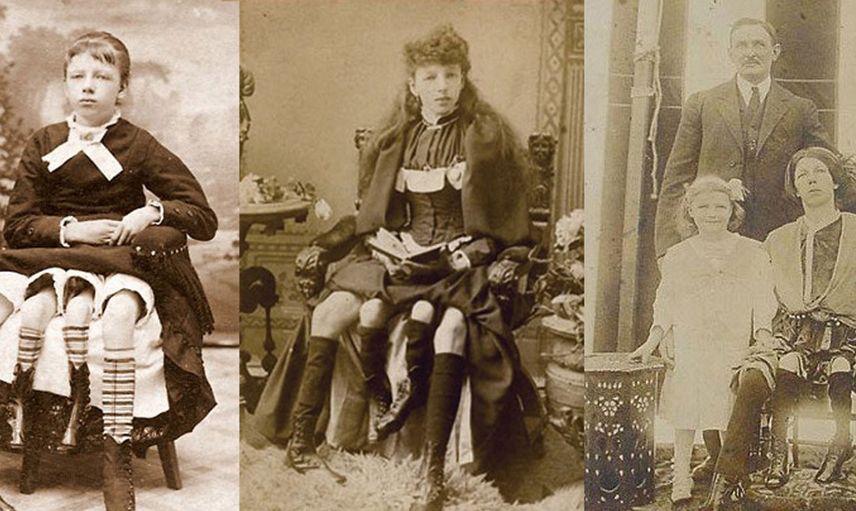 Dört bacak ve iki rahimle doğan kadın Myrtle Corbin'nin hayat hikayesi