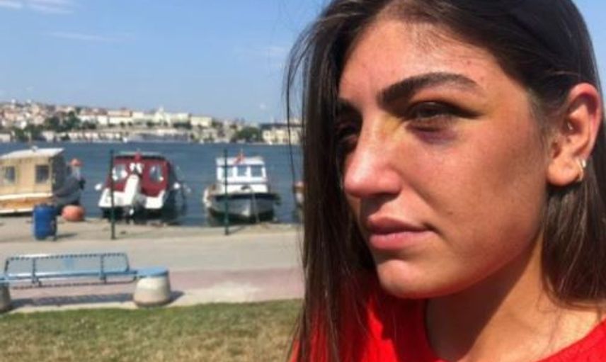 Manken Gizem Akbaş Eski Sevgilisi Tarafından Darp Edildi