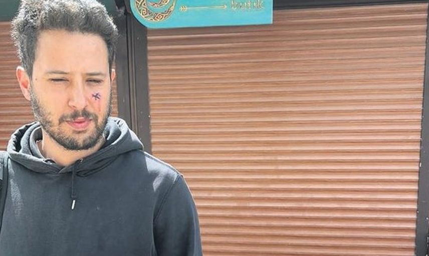 Ünlü oyuncu Tuan Tunalı’ya köpek saldırdı! Yüzü paramparça oldu