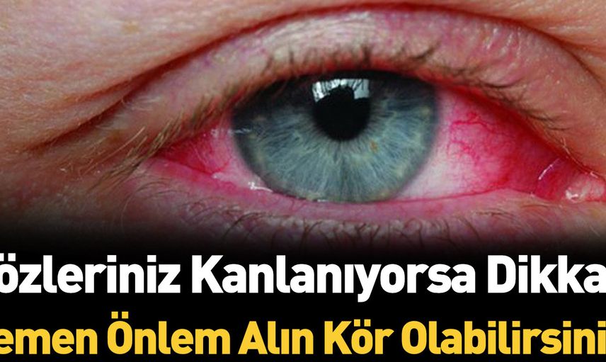Gözünüzün kanlanmasını ihmal etmeyin kör olabilirsiniz!