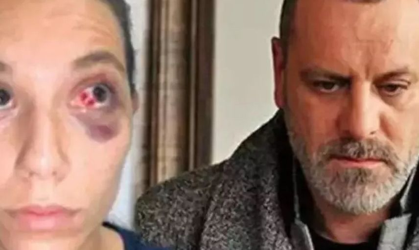 Ozan Güven'in eski sevgilisi Deniz Bulutsuz'u darp ettiği davada son gelişme: Adli Tıp Kurumu raporu hazırladı