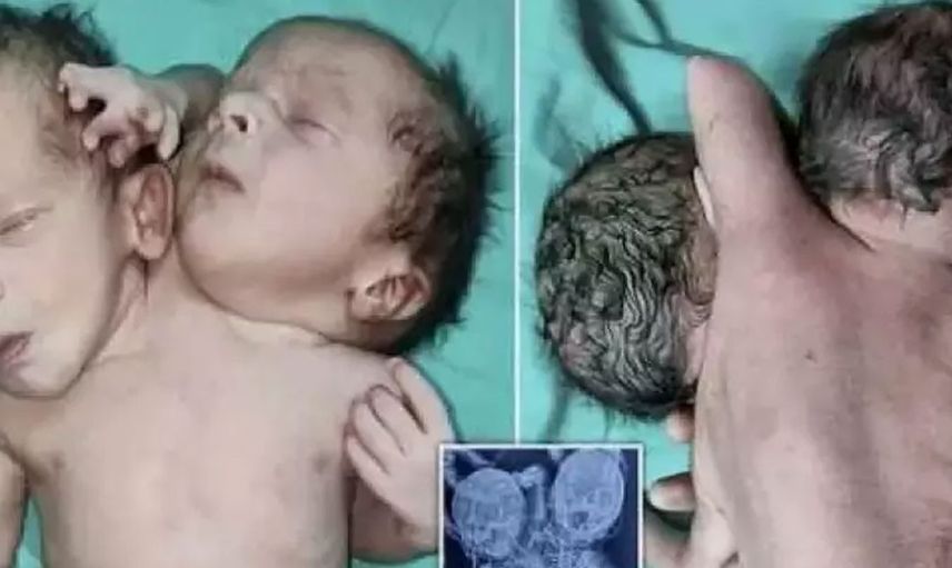 Hindistan’da doğum yapan anneye büyük şok! İkiz bekliyordu ama gerçek…