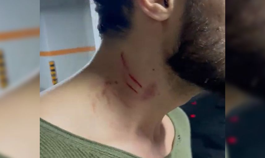 Eski sevgililerin şiddet kavgası! Batuhan Karacakaya'nın darp görüntüleri ifşa oldu!