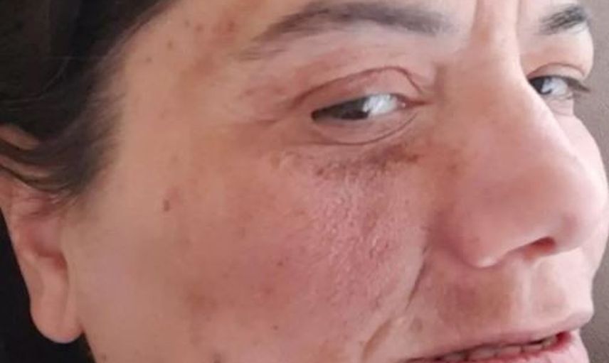Damak Ağrısı Diye Gitti Yanlış Tedavi Yüzünden Hayatı Karardı