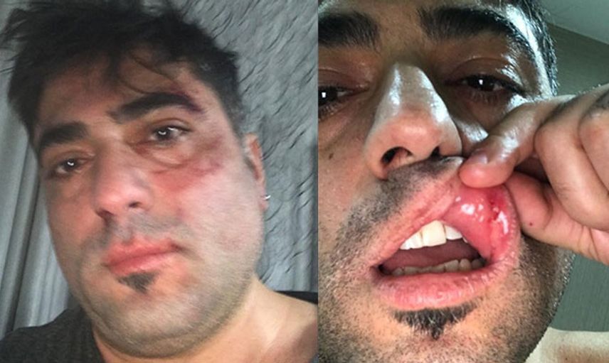İzmir’de Kadın Eşinin Gözlerini Oymaya Çalıştı