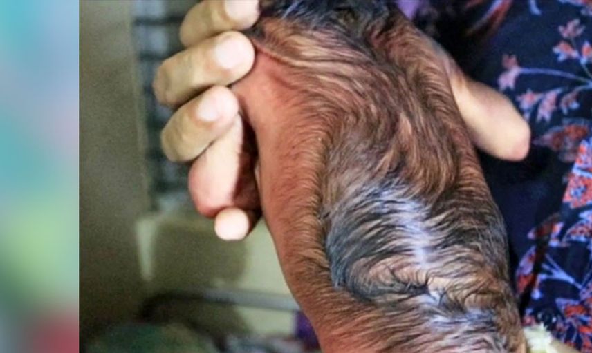 3 günlük bebek erken yaşlanma hastalığına yakalandı