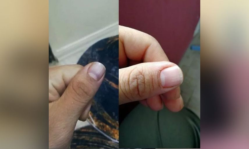 Sakarya'da ilginç bir vaka! Elleri ayakları bir anda morarıyor hastalığının adı bile yok