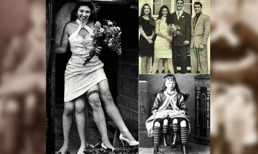 Dört bacak ve iki rahimle doğan kadın Myrtle Corbin'nin hayat hikayesi