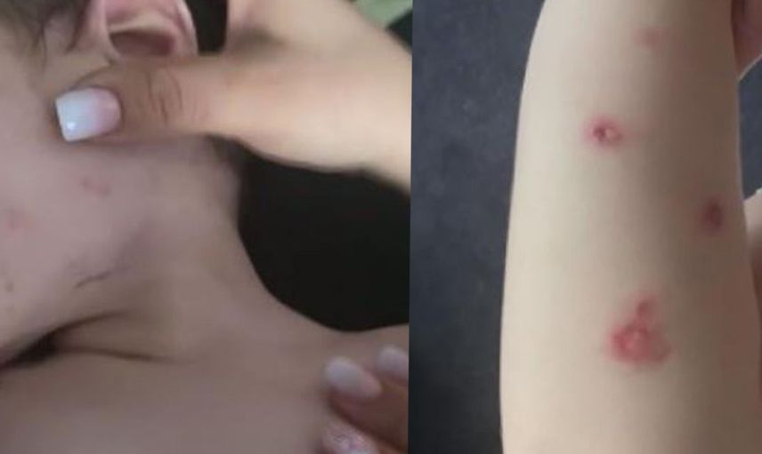 Öz Babası Tarafından Üzerinde Sigara Söndürülen 1,5 Yaşındaki Bebeğin Durumu Kötü!