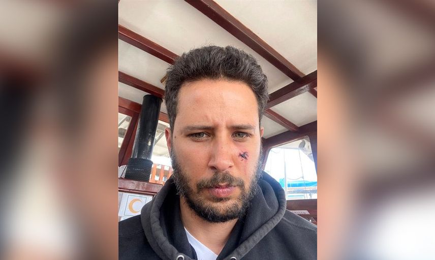 Ünlü oyuncu Tuan Tunalı’ya köpek saldırdı! Yüzü paramparça oldu