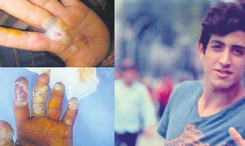 Radyoaktif Tespih Yüzüden Yüzde 80 Engelli Kaldı