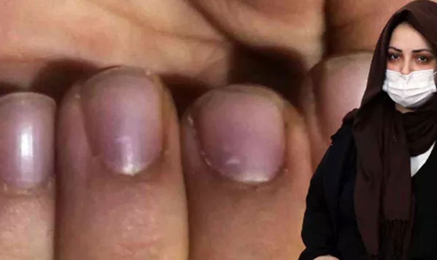 Sakarya'da ilginç bir vaka! Elleri ayakları bir anda morarıyor hastalığının adı bile yok