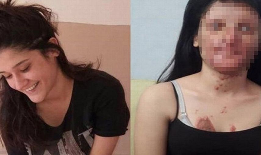 Yüzünü Yakan Kişiyle Evlenen Berfin Özek’in Babası Konuştu