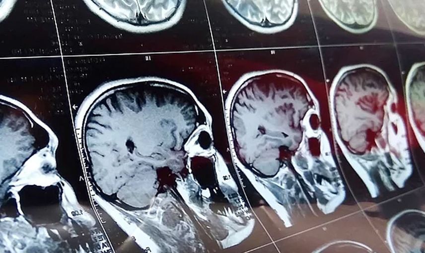 Kovid Geçirenlerde IQ Kaybı Meydana Geliyor