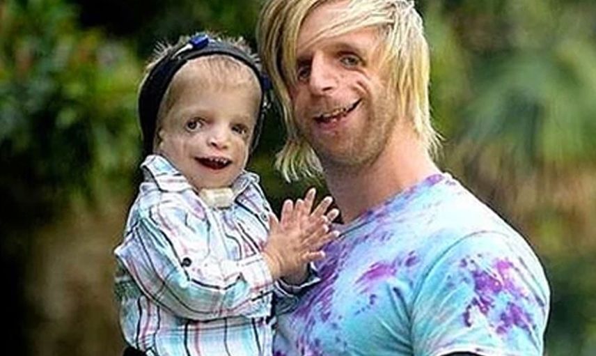 Yeni doğan bebeklerinin yüzünü görünce hastaneden kaçtılar: Jono Lancaster'ın hikayesi herkesi duygulandırdı