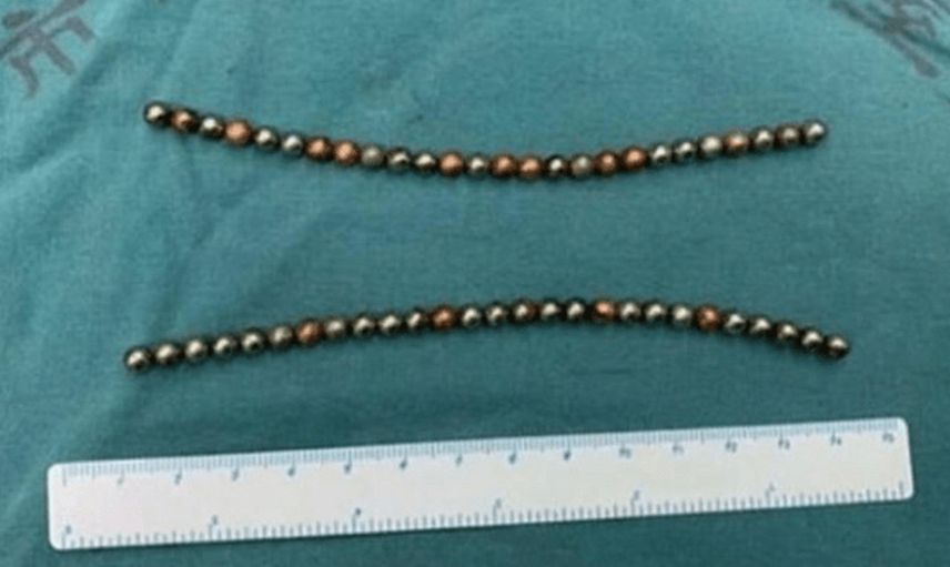 14 yaşındaki çocuk erkeklik organına 53 tane manyetik top soktu