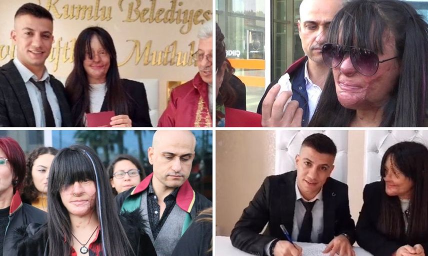 Yüzünü Yakan Kişiyle Evlenen Berfin Özek’in Babası Konuştu