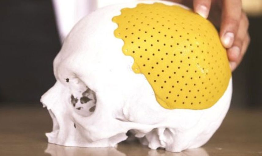 Teknoloji daha ne kadar ilerleyecek! Kafatası olmayan bebek 3D yazıcı ile yapay kafatasına sahip olarak hayatta kaldı