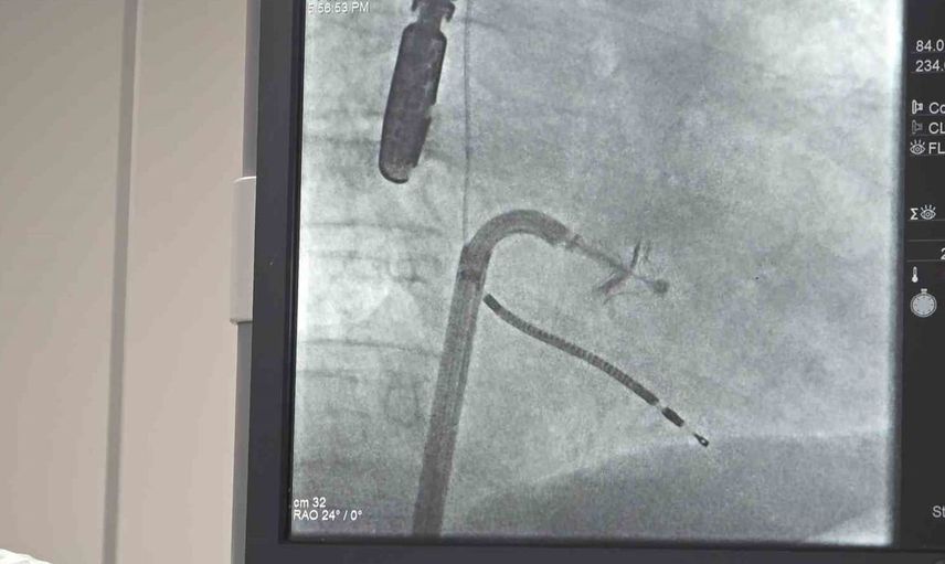 Açık kalp ameliyatı gerektirmeyen mitral kapak onarımı başarılı şekilde yapıldı