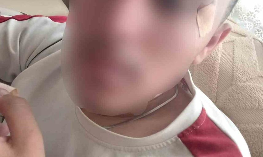 Öğrenci-öğretmen arasında yaşanan suçlamalı olayda burnu kırılan çocuğun durumu ağırlaştı