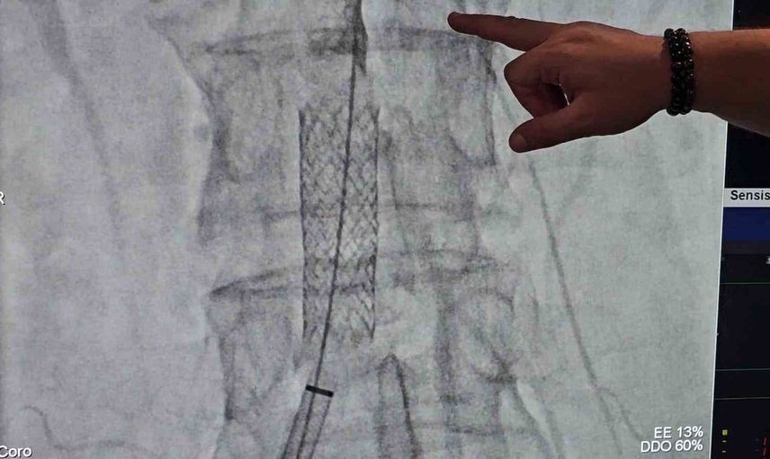 Şiddetli öksürük sonucu kalp damarı yırtılan kadının kurtuluş hikayesi