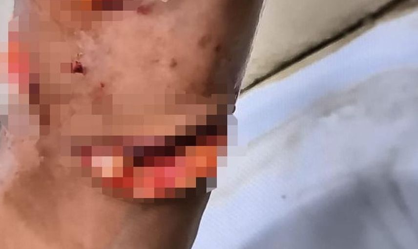 Suruç’ta başıboş köpekler 8 yaşındaki çocuğa saldırdı