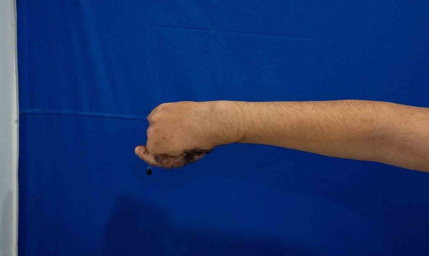 Kasapta çırak olarak çalışan çocuğa başparmak nakli yapıldı