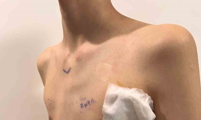 Samsun'da genç hastanın kunduracı göğsü kapalı yöntemle düzeltildi