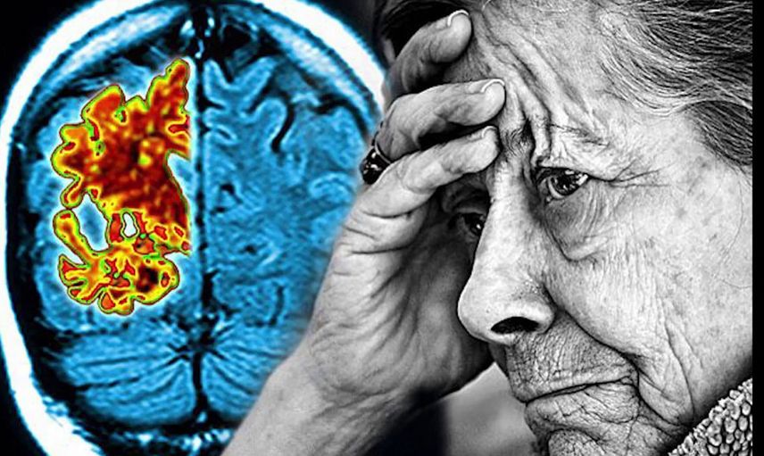 Alzheimer hastalığı artık tarihe karışıyor! Hastalara tünelin ucunda ışık göründü!