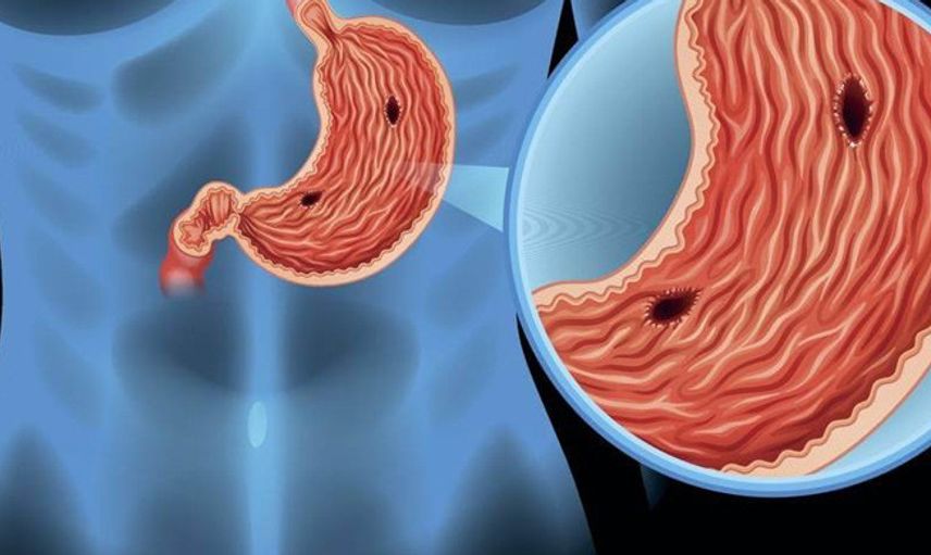 Antral Gastrit Nedir?
