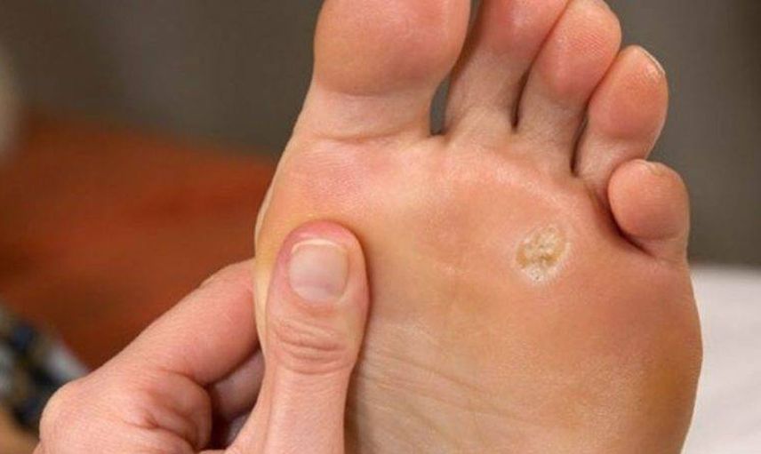 Ayak çıbanı nedir? Tedavi yöntemleri nelerdir?