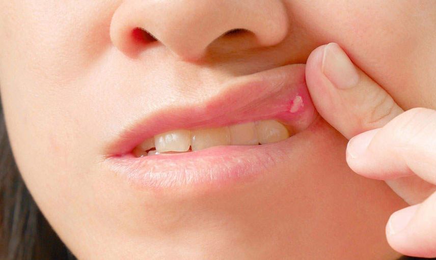 Behçet hastalığı nedir, belirtileri nelerdir, kendiliğinden geçer mi, bulaşıcı mıdır, tedavisi var mı? Körlüğe yol açan Behçet hastalığıyla ilgili bilinmesi gerekenler