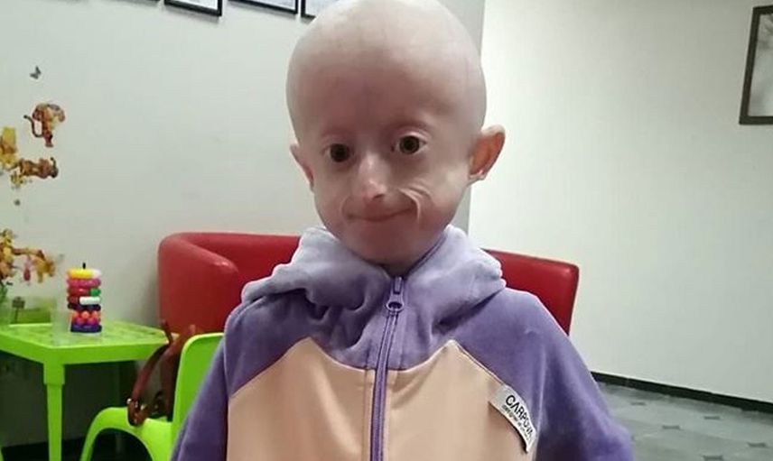 Benjamin Button Hikayesi Gerçek Oldu! 10 Yaşındaki Çocuk Yaşlılıktan Öldü