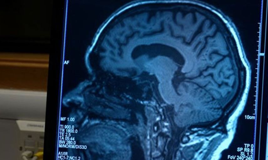 Bir Hastalığın Daha Çaresi Bulundu! Bilim insanları Alzheimer'ı Durdurmanın Yöntemini Açıkladı