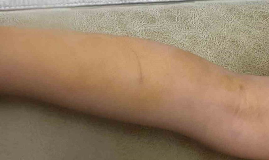 Halfeti'de sahipsiz köpeğin saldırdığı çocuk yaralandı