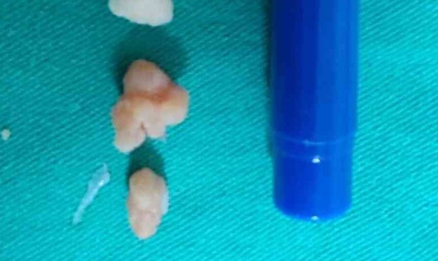Patnos'ta dirsek artroskopisi ile sağlıklarına kavuşuyorlar