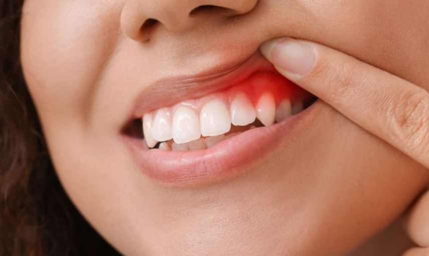 Diş eti iltihabı neden oluşur? Diş eti iltihabına iyi gelen besinler ve tedavisi