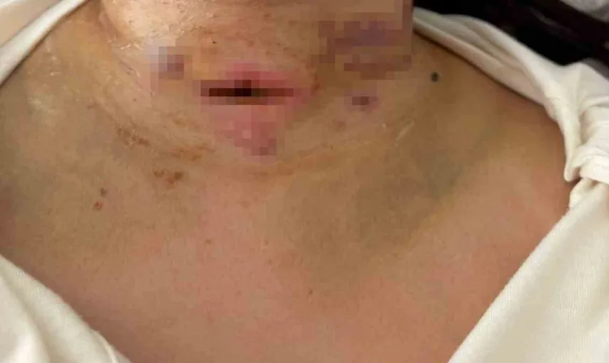 Gıdı estetiği sonrası hayatı tehlikeye girdi: Nefes almak için acil müdahale şarttı