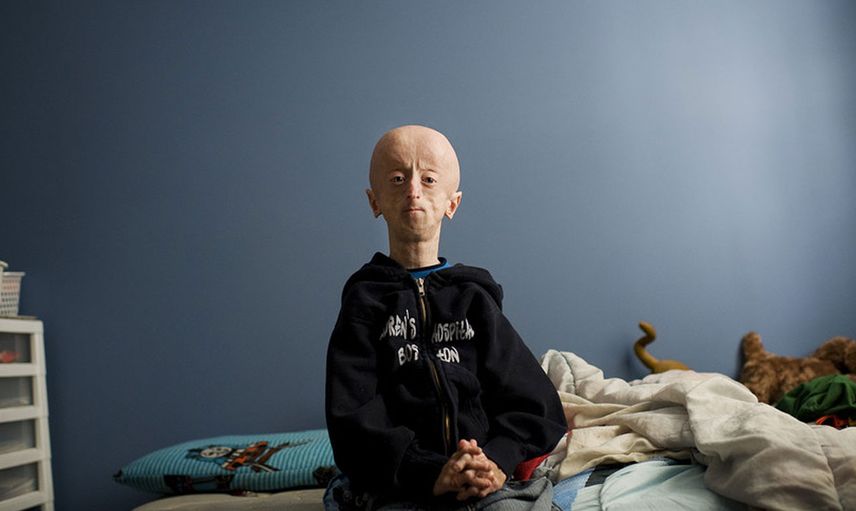 Erken Yaşlanma Hastalığı Progeria Nedir, Belirtileri Neler?