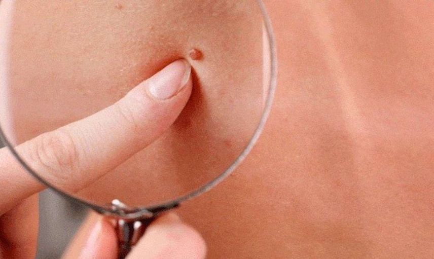 Et beni nedir, nasıl düşürülür? Et benlerini döken evde hazırlayabileceğiniz doğal tarifler