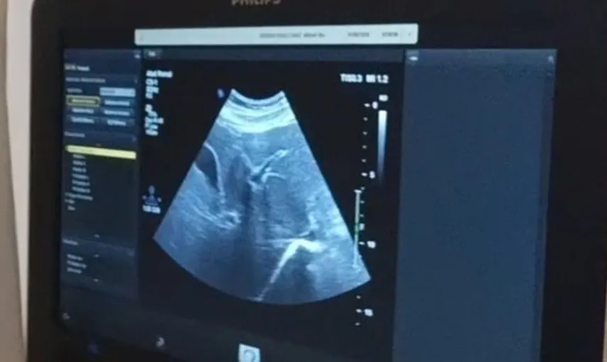 Siverek'te kronik hepatit B hastalarına özel karaciğer biyopsisi uygulaması başladı