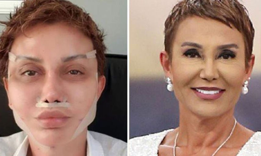 Fransız Askısı Yaptıran Serap Paköz Bandajları Çıkardı! Son Halini Sosyal Medyadan Paylaştı