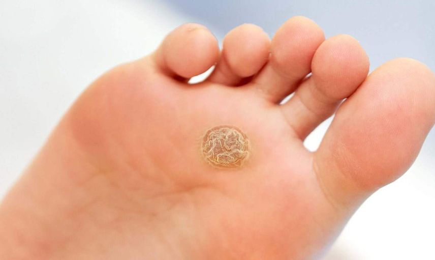 Genital siğil nedir, nasıl oluşur? 2022 Genital siğil tedavi yöntemleri